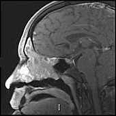 Squamous Cell Cancer of Ethmoids,MRI