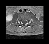 Chronic Demyelinating Polyneuropathy,MRI