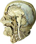 Head and Brain,Gross Specimen