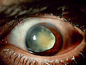 Cataract