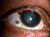 Scleral Nevus