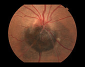 Optic Nerve Melanoma