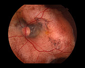 Choroidal Osteoma