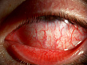 Conjunctivitis