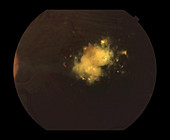 Cholesterol Crystal Deposites