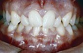 Crowded Teeth Before Treatment