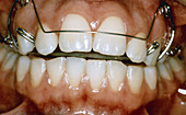 Orthodontic Appliance
