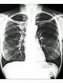 Bronchial Cancer,X-ray