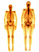 Human Body,Scintigraphy