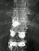 Vertebroplasty,X-ray