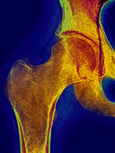 Normal Hip,X-ray