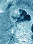 Renal Infarction,Angiogram
