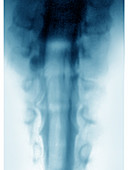 Meningocele,X-ray
