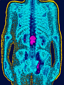 Osteoporosis,Scintigraphy