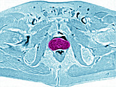 Prostate,MRI