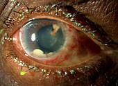 Anterior Infection in Eye