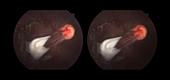 Scar and Macular Dragging (stereo image)
