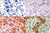 Breast Cancer Cells,Composite