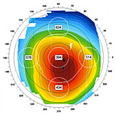 Astigmatism,Ophthalmic Medicine