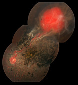 Capillary Hemangioma,Ophthalmic Medicine