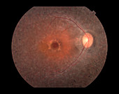 Macular Hole,Ophthalmic Medicine