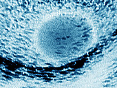 Ultrasound showing Testicular Cancer