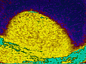 Ultrasound of Hydrocele around Testicle
