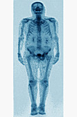 Obese Person,Gamma Scan