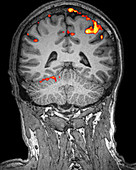 Brain,Functional MRI (fMRI)