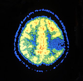 PET Scan of Brain Tumour