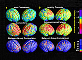 Schizophrenia,3D MRI Scans