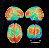 Bipolar Brain,3D MRI Scan