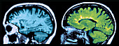 MRI of Normal Brain and MS Lesions