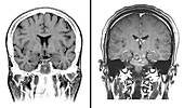 MRI of Normal Brain and MS Lesions