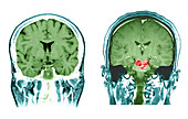 MRI of Brainstem Malformations