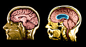 MRI of Hydrocephalic Brain