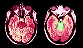 MRI of Normal Brain and Brainstem Glioma