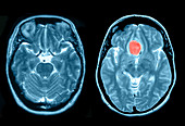 Normal Brain and Meningioma