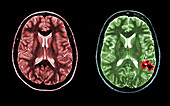 MRI of Normal and AVM Brains
