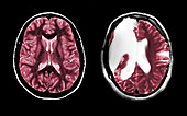 MRI of Normal Brain and Hemispherectomy