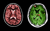 MRI of Normal and Tumour-Filled Brains