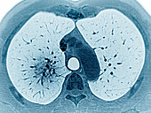 Pulmonary Arteritis