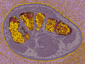 Cuneiform Bone Fracture,CT Scan