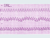 ECG showing Atrial Flutter