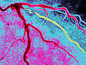 Myocardial Infarction,Angiogram