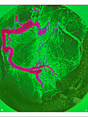 Myocardial Infarction,Angiogram