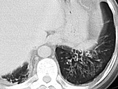 Cystic Fibrosis,CT Scan