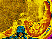 Cystic Fibrosis,CT Scan