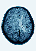 Cerebral Oedema,CT