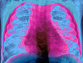 Pneumonia,Chest X-ray